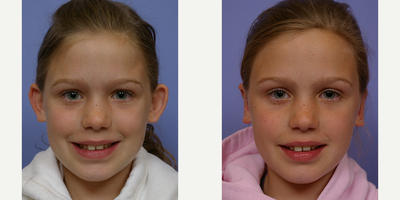 Ear Surgery before and after photo