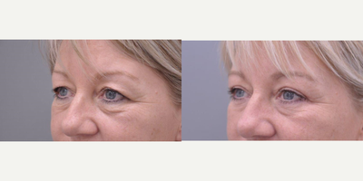 Eyelid Surgery before and after photo