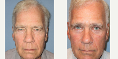 Eyelid Surgery before and after photo