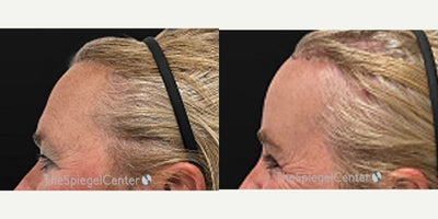 Forehead Reduction before and after photo