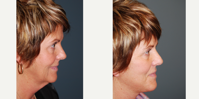 Mini Facelift before and after photo
