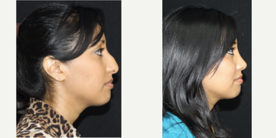 Rhinoplasty before and after photo