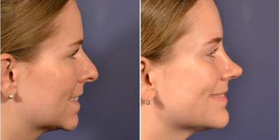 Rhinoplasty before and after photo