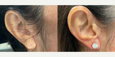 Earlobe Repair before and after photo