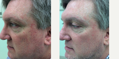 Excel V before and after photo
