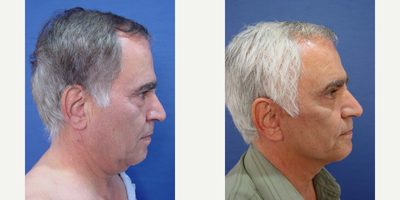 Facelift before and after photo