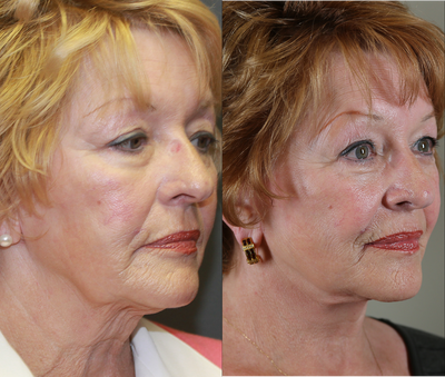 Facelift before and after photo