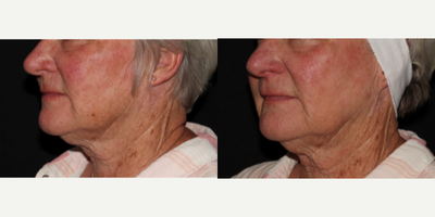 before and after image