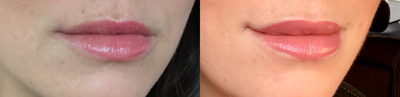 Volbella before and after photo
