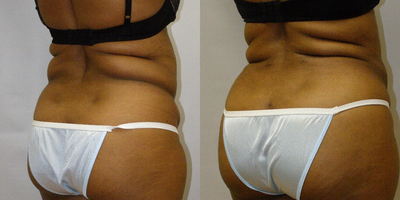 Brazilian Butt Lift before and after photo