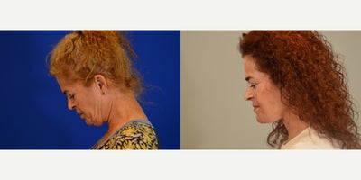 Deep Plane Facelift before and after photo