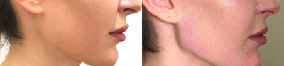 Dermal Fillers before and after photo