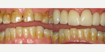 Smile Makeover before and after photo