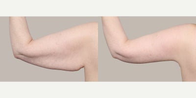 Arm Lift before and after photo