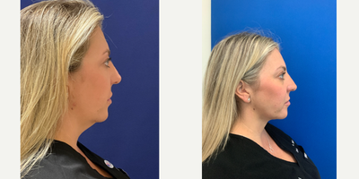 Buccal Fat Removal before and after photo