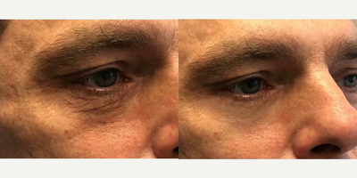 CO2 Laser before and after photo
