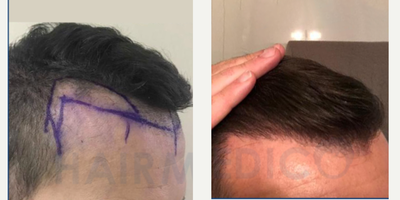 Fractional Laser before and after photo