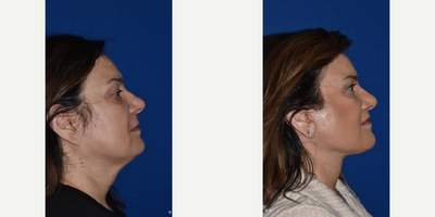 Neck Lift before and after photo