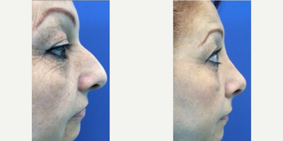 Rhinoplasty before and after photo