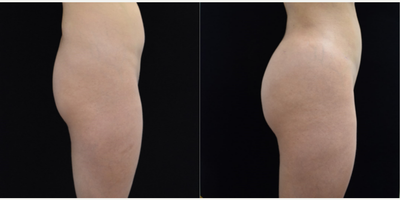 Brazilian Butt Lift before and after photo