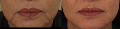 Juvederm before and after photo