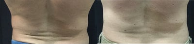 SculpSure before and after photo