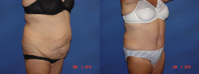 Tummy Tuck before and after photo