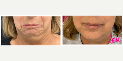 Botox before and after photo