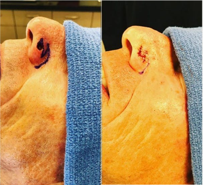 Mohs Surgery before and after photo