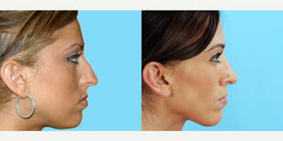 Rhinoplasty before and after photo