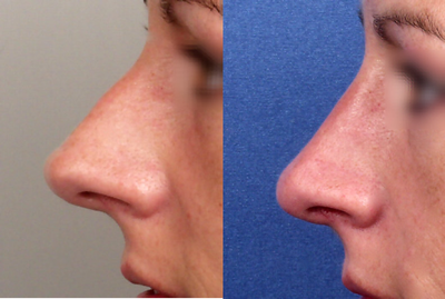 Rhinoplasty before and after photo
