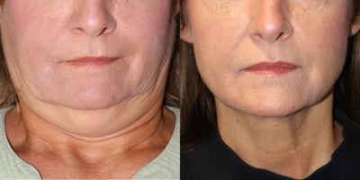 before and after image