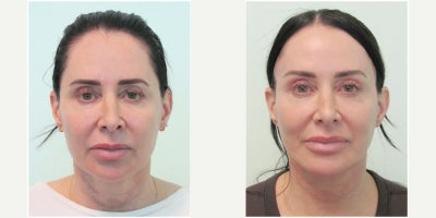 Brow Lift before and after photo