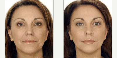 Restylane Lyft before and after photo