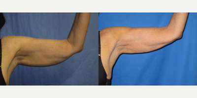 Smart Lipo before and after photo