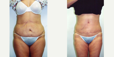 Tummy Tuck before and after photo