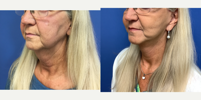 Facelift before and after photo