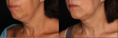 Kybella before and after photo