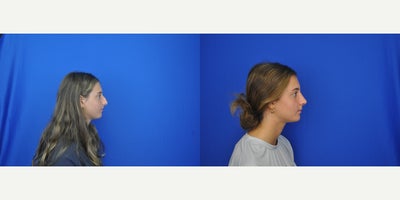 Septoplasty before and after photo