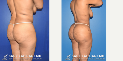 Brazilian Butt Lift before and after photo