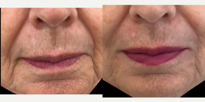 Dermal Fillers before and after photo