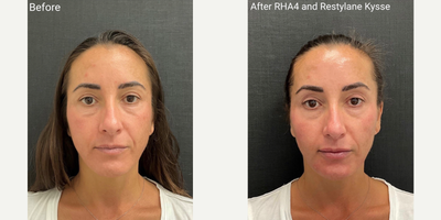 Dermal Fillers before and after photo
