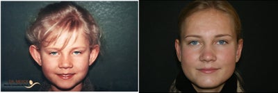 Ear Surgery before and after photo