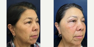 Eyelid Surgery before and after photo