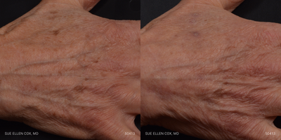 Fraxel Laser before and after photo