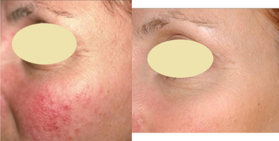 Laser Resurfacing before and after photo