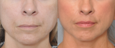 Lip Lift before and after photo