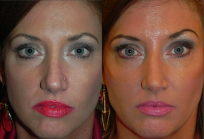 Mole Removal before and after photo