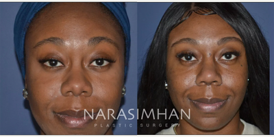 African American Rhinoplasty before and after photo