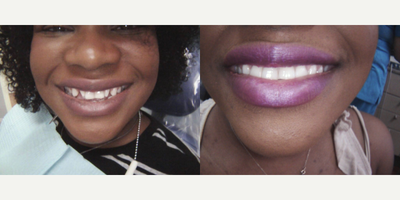 Dental Crown before and after photo